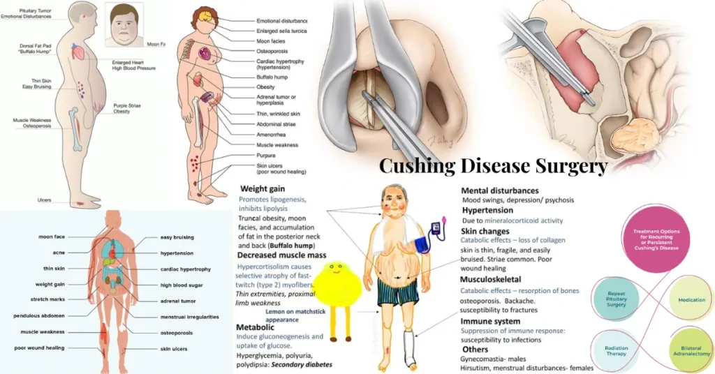 cushing disease surgery