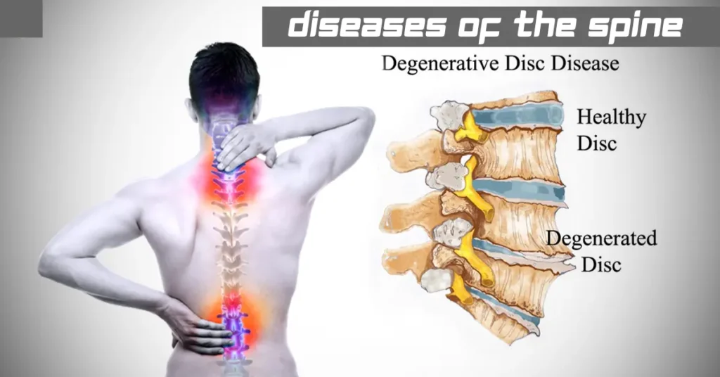 diseases of the spine